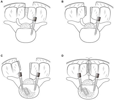 Unilateral transforaminal lumbar interbody fusion through a modified hemilateral spinous process-splitting approach